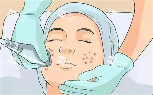 祛痘治疗