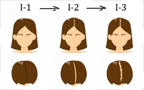 轻度脱发素材 轻度脱发素材