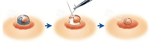 乳头缩小术过程