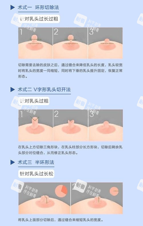 乳头缩小术切口演示动画图