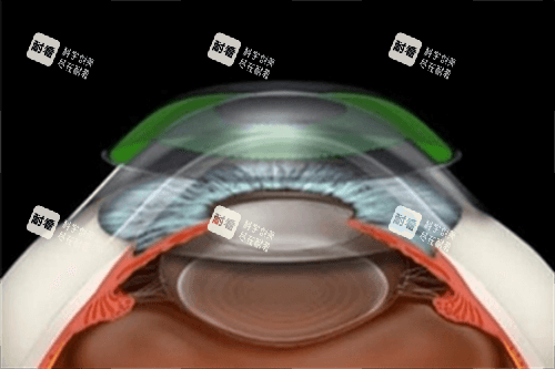角膜塑形镜原理示意图 角膜塑形镜原理示意图