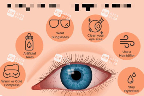 干眼症治疗方法