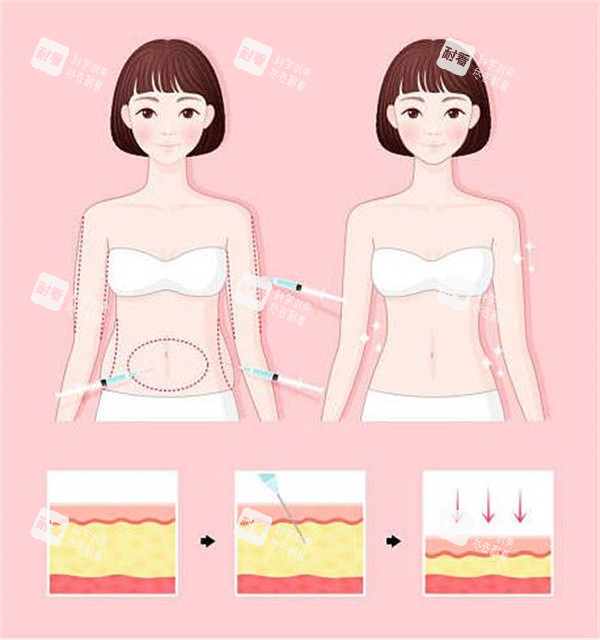 腰腹吸脂对比