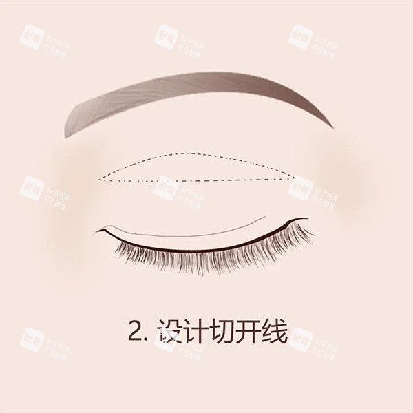 双眼皮手术 双眼皮手术
