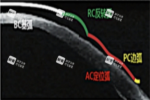 角膜塑形镜各弧区示意图