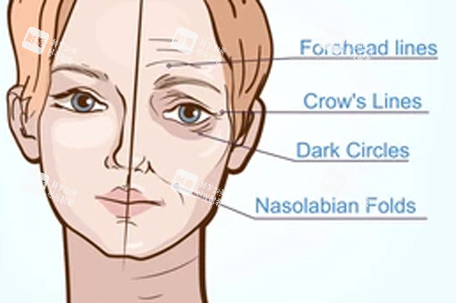 人体衰老形成的不同皱纹 人体衰老形成的不同皱纹