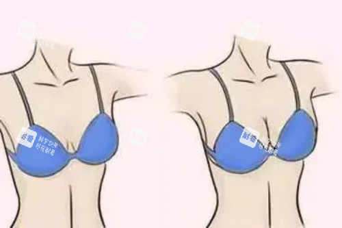 假体丰胸卡通对比图