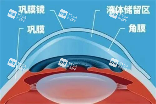 巩膜镜结构图 巩膜镜结构图