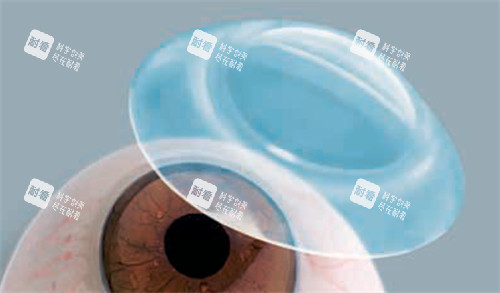 巩膜镜展示图 巩膜镜展示图