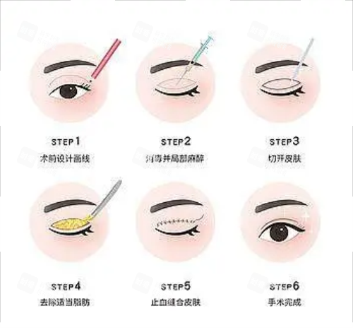 全切双眼皮流程图示