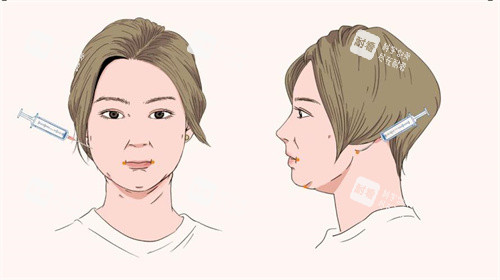 面部吸脂手术针管注射点位动画图