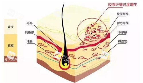 增生疤痕示意图