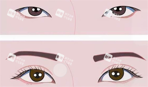 双眼皮前后对比 双眼皮前后对比