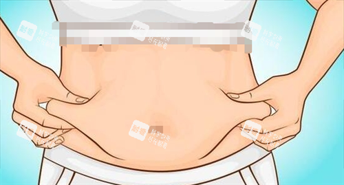 吸脂手术腹部脂肪堆积