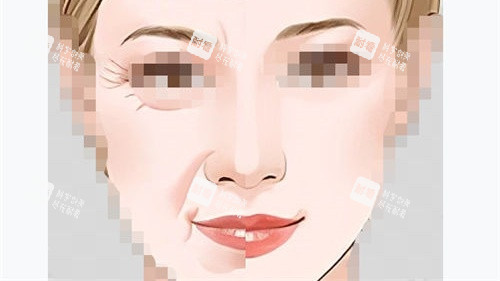 拉皮手术前后对比示意图.jpg 拉皮手术前后对比示意图.jpg