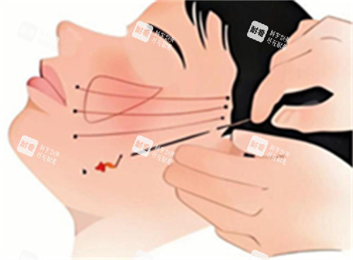 脸部拉皮卡通图 脸部拉皮卡通图