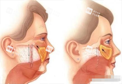 拉皮前后皮肤内部以及表面变化图