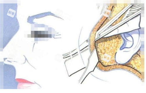 拉皮手术手术剖面图