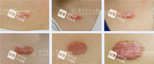 疤痕疙瘩图示 疤痕疙瘩图示