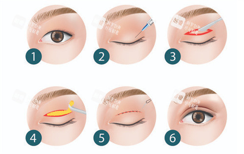 双眼皮全切手术过程