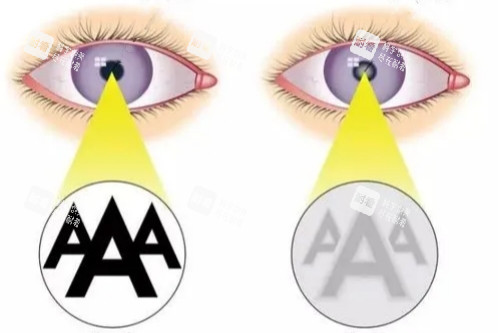 白内障与正常眼睛视物卡通对比图 白内障与正常眼睛视物卡通对比图