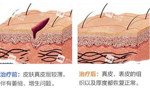 激光祛疤前后对比示意图