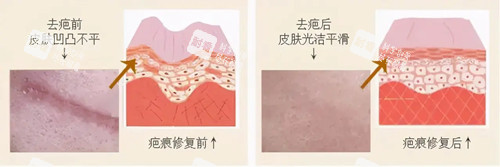 激光祛疤卡通示意图