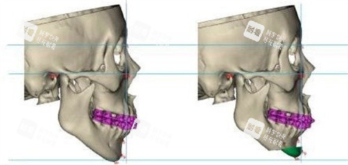 颏成型手术 颏成型手术