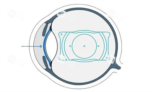 爱尔眼科晶体植入多少钱？2026价格表出炉，ICL/TICL 费用+真实评价