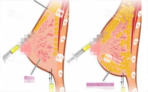 胸部脂肪填充过程呈现图