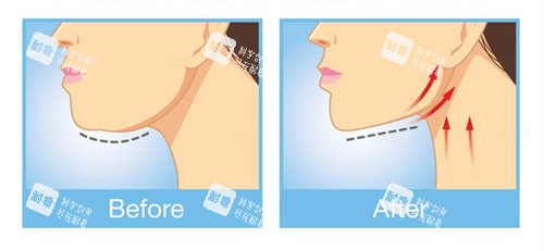下巴提升紧致整形前后对比图
