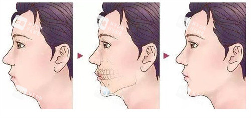 垫下巴手术