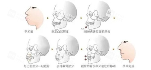 正颌手术步骤图示