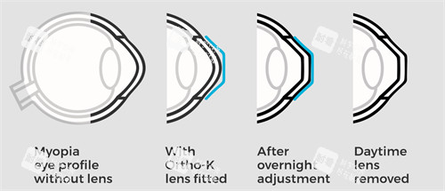 角膜塑形镜改善流程