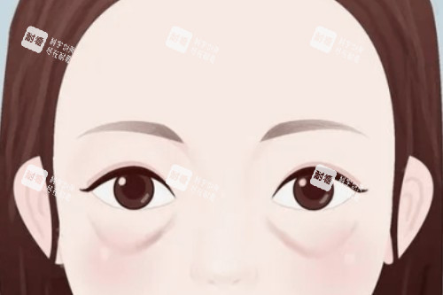眼袋卡通展示图
