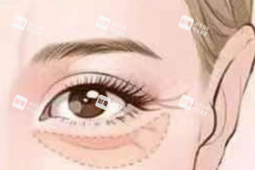 眼袋整形卡通图