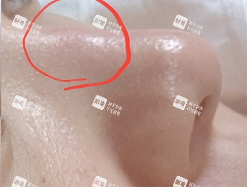 隆鼻炎症透光图片