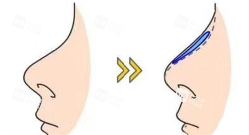 隆鼻鼻背假体前后对比图