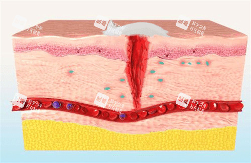 生长因子可以促进皮肤疤痕修复 生长因子可以促进皮肤疤痕修复