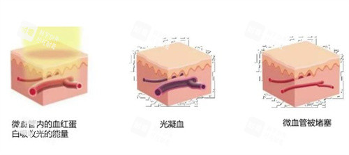 造成红血丝的几种原因 造成红血丝的几种原因