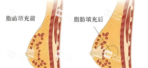 自体脂肪隆胸脂肪对比