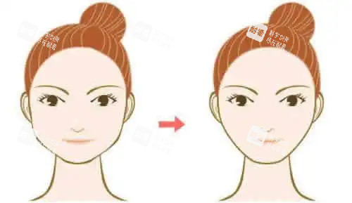 下颌角整形对比图