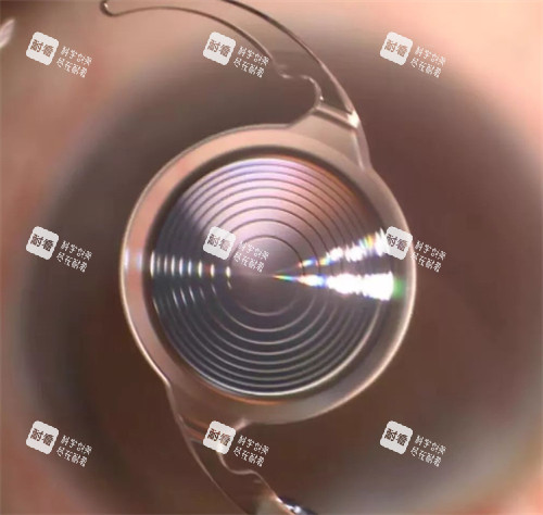 白内障竟晶体示意图