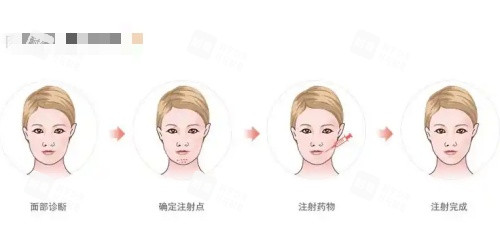 骸肌放松注射过程示意图