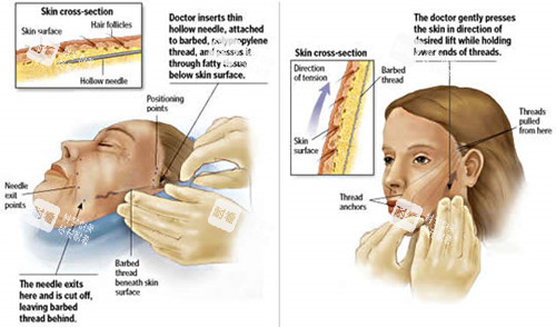 面部提升图片对比