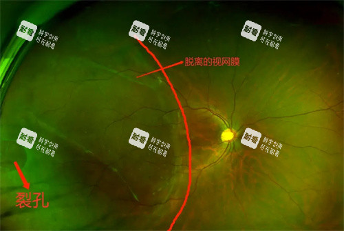 孔源性视网膜脱离的图 孔源性视网膜脱离的图