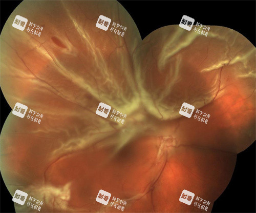 孔源性视网膜脱离放大以后得照片 孔源性视网膜脱离放大以后得照片