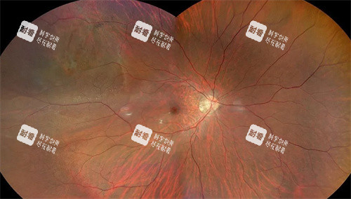 孔源性视网膜脱离放大图 孔源性视网膜脱离放大图