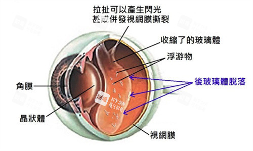 视网膜脱落的眼球 视网膜脱落的眼球