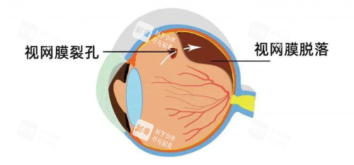 视网膜脱落裂孔示意图 视网膜脱落裂孔示意图